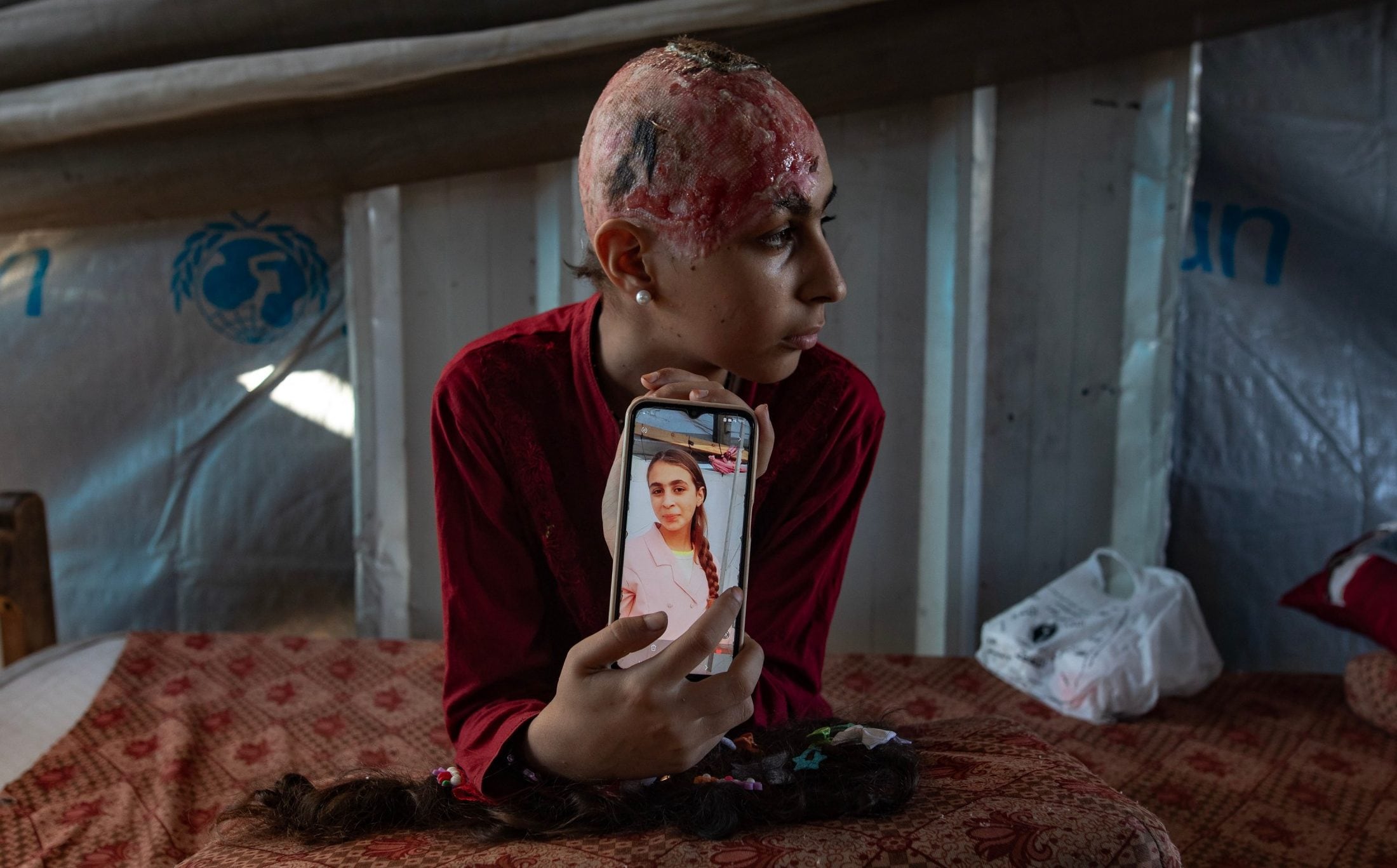 I lost my hair in an Israeli air strike. Now other children are scared of me